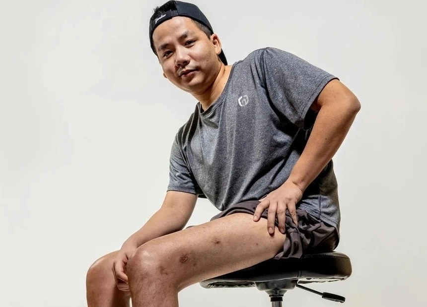 Khoa Pug chi 3 tỷ kéo chân lần 2 tại Thổ Nhĩ Kỳ: Bác sĩ cảnh báo rủi ro